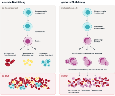 Abb. 1: Schematische Darstellung der normalen Blutbildung und der gestörten Blutbildung bei einer akuten myeloischen Leukämie. Quelle: Blutspende SRK Schweiz (2023)