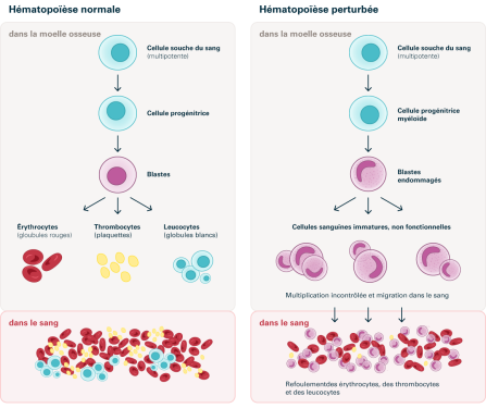 Schéma 1: Présentation schématique d'une hématopoïèse normale et d'une hématopoïèse anormale lors d'une leucémie myéloïde aiguë. Source: Transfusion CRS Suisse (2023)