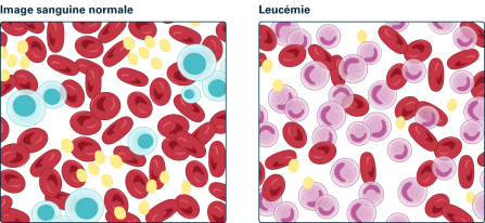 Schéma 2: Dans l'image sanguine de gauche, on voit principalement des érythrocytes (cellules sans noyau) et quelques leucocytes matures (bleu clair). Dans l'image sanguine de droite, qui montre une leucémie, on reconnaît des cellules leucémiques (violettes) et une faible quantité d'érythrocytes. Source: Transfusion CRS Suisse (2023)